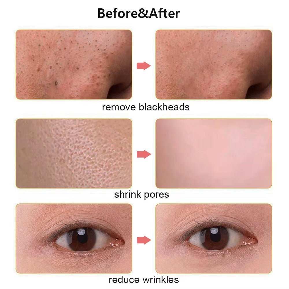 Ultrasonic Face Scrubber Facial Peeling Skin Scrubber Deep Facial Cleaning Spatula Acne Pore Ultrasonic Scrubber Facial Cleanser - AMIR BAGS INDIA PRIVATE LIMITED